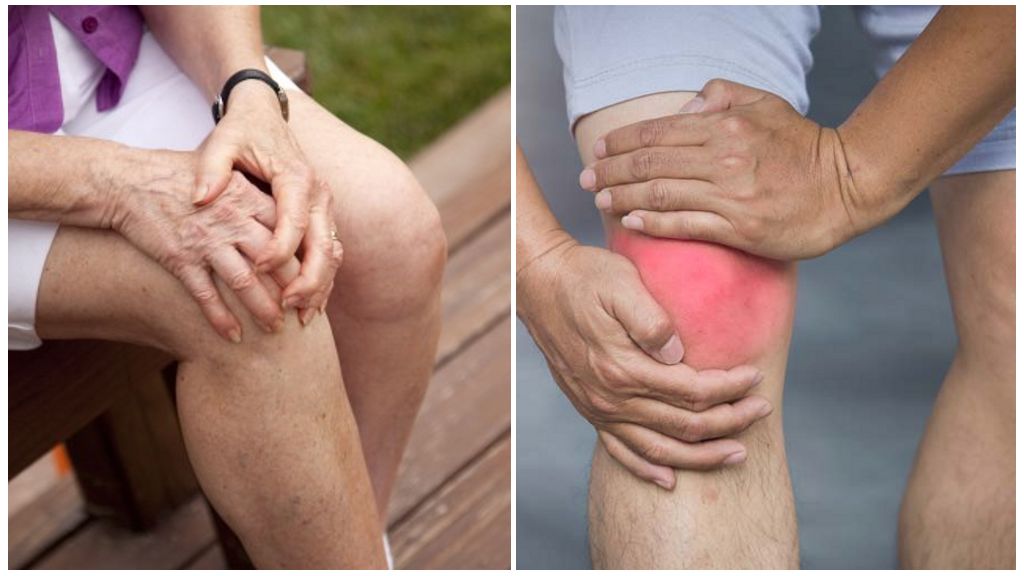 Артроз коленного сустава (гонартроз)